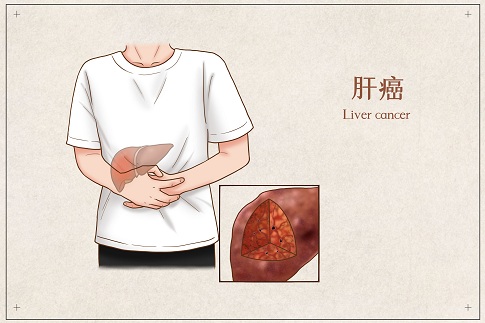1653321154268908.jpg 攝圖網_401794893_banner_肝癌醫療插畫(企業商用).jpg