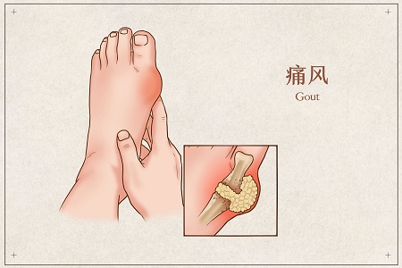 1653843131531128.jpg 攝圖網_401794683_banner_痛風醫(yī)療插畫(企業(yè)商用).jpg