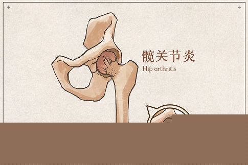 1655656942198987.jpg 攝圖網_401789354_髖關節炎示意圖(企業商用).jpg