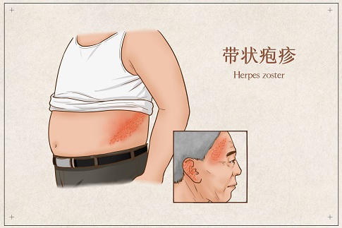 1655737958179292.jpg 攝圖網_401800774_banner_帶狀皰疹醫療插畫(企業商用).jpg
