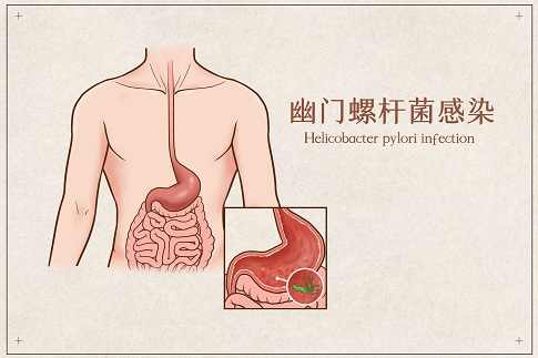 1656435302709896.jpg 攝圖網(wǎng)_401789751_banner_幽門螺桿菌感染醫(yī)療插畫(huà)(企業(yè)商用).jpg