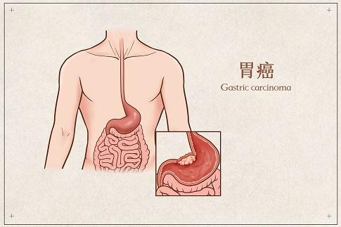 1657043293833817.jpg 攝圖網_401789678_胃癌醫療插畫(企業商用).jpg