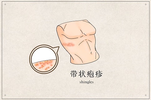 1659282562432061.jpg 攝圖網_401789790_帶狀皰疹醫療插畫(企業商用).jpg
