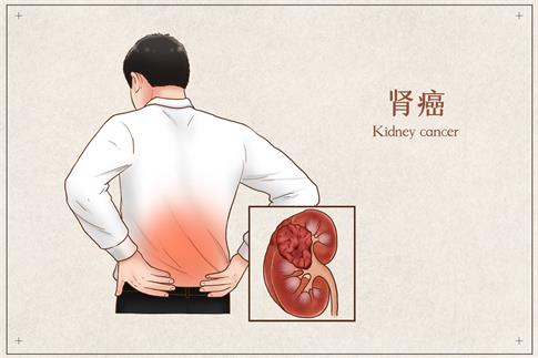 1679423979985177.jpg 攝圖網(wǎng)_401793821_banner_腎癌醫(yī)療插畫(企業(yè)商用).jpg