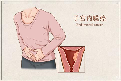 1693784407646926.jpg 攝圖網_401866465_banner_子宮內膜癌醫療插畫(企業商用).jpg