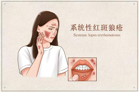 1701735967437085.jpg 攝圖網_401794490_系統性紅斑狼瘡醫療插畫(企業商用).jpg