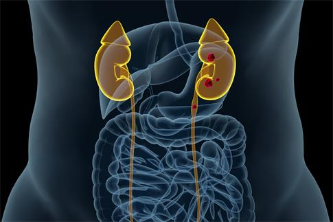 1701820962141114.jpg 攝圖網(wǎng)_401860884_腎結(jié)石病變場景(企業(yè)商用).jpg