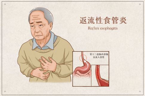 1705739233702908.jpg 攝圖網_401804083_反流性食管炎醫療插畫(企業商用).jpg