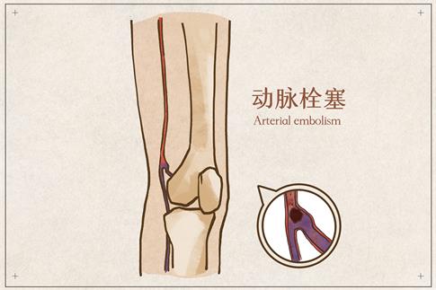 1708917056371122.jpg 攝圖網_401790480_動脈栓塞醫療插畫(企業商用).jpg