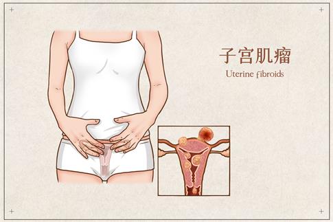 1709511232282588.jpg 攝圖網(wǎng)_401800161_子宮肌瘤醫(yī)療插畫(企業(yè)商用).jpg