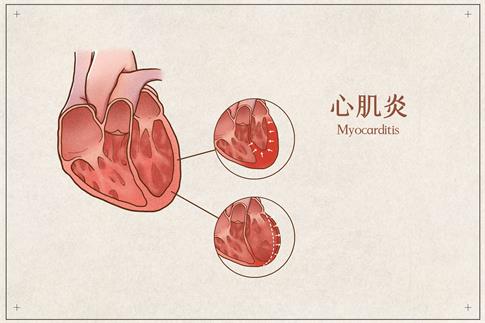 1716259127897064.jpg 攝圖網_401789429_心肌炎醫療插畫示意圖(企業商用).jpg