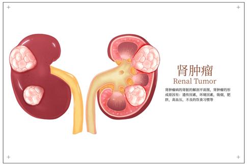 1751513635268596.jpg 攝圖網(wǎng)_402717159_banner_器官腎腫瘤解剖圖醫(yī)學分析插畫(企業(yè)商用).jpg